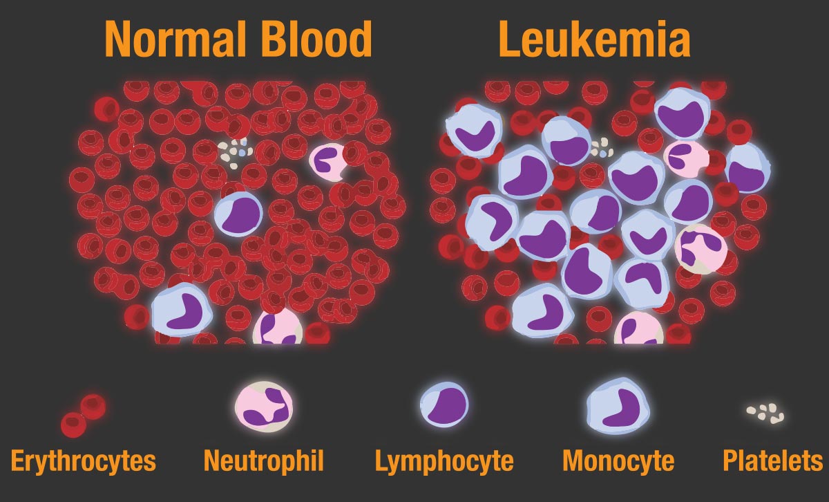 Lymphatic & Blood Cancer Facts & Symptoms | UHC Oncology